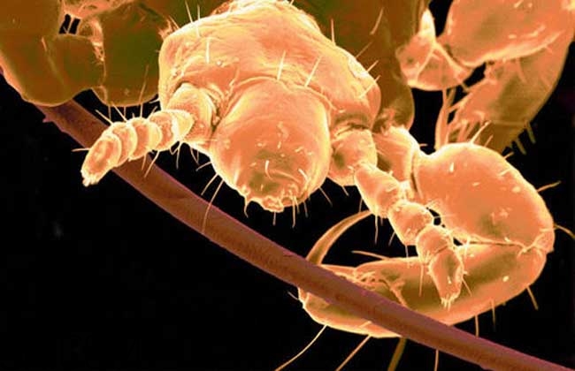 孩子長虱子是怎么回事？孩子長虱子該怎么辦？