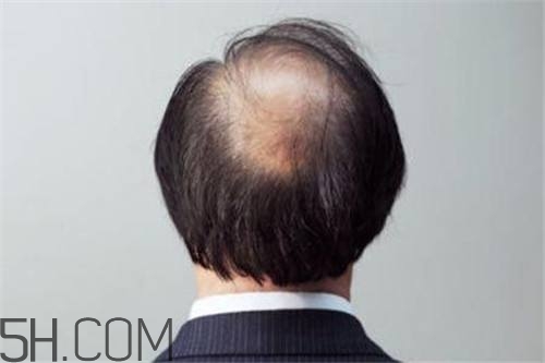 為什么男性比女性更容易脫發(fā)？什么原因?qū)е履行悦摪l(fā)？