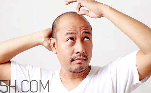 為什么男性比女性更容易脫發(fā)？什么原因?qū)е履行悦摪l(fā)？