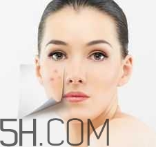 濕熱型痤瘡是什么？怎么調(diào)理濕熱型痤瘡？