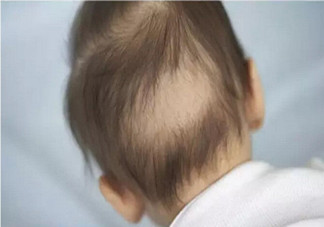 寶寶枕禿怎么辦？如何改善寶寶枕禿現(xiàn)象？