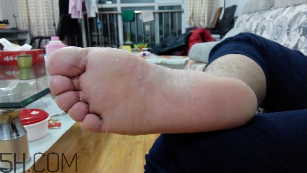 腳氣可以用酒精消毒嗎？腳氣可以用碘伏消毒嗎？