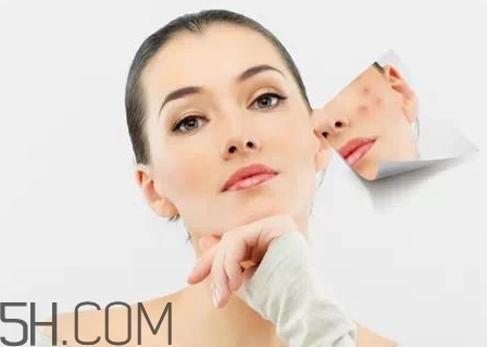 刷酸爆痘期有多長(zhǎng)？刷酸要爆幾周的痘？