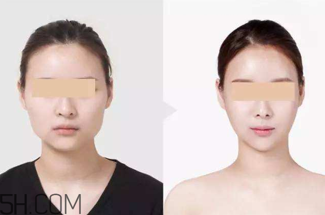 打瘦臉針可以抽煙嗎？打瘦臉針會(huì)反彈嗎？