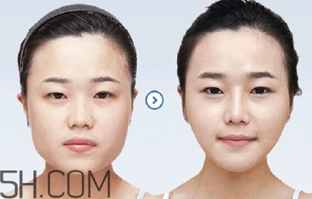 打瘦臉針可以抽煙嗎？打瘦臉針會(huì)反彈嗎？