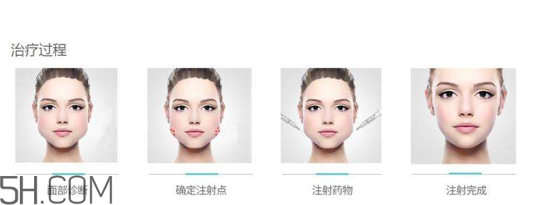 打瘦臉針可以抽煙嗎？打瘦臉針會(huì)反彈嗎？