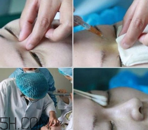 玻尿酸多少錢一支？打玻尿酸有危害嗎？