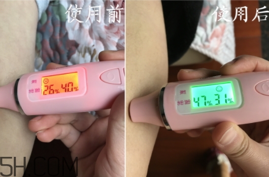 水楊酸可以去黑頭嗎？水楊酸可以去閉口嗎