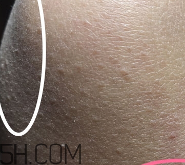 水楊酸可以去黑頭嗎？水楊酸可以去閉口嗎