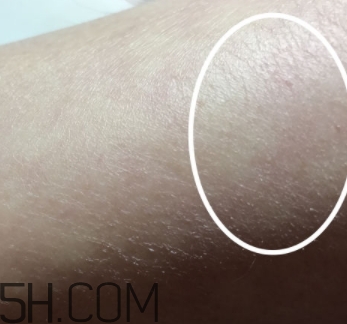 水楊酸可以去黑頭嗎？水楊酸可以去閉口嗎