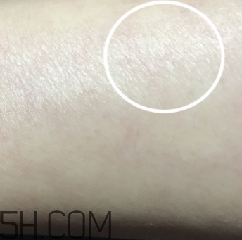 水楊酸可以去黑頭嗎？水楊酸可以去閉口嗎