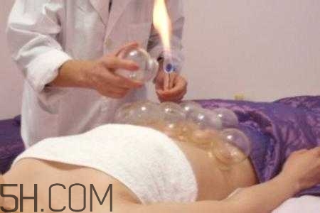 腹部拔罐可以減肥嗎？腹部拔罐拔哪個位置？