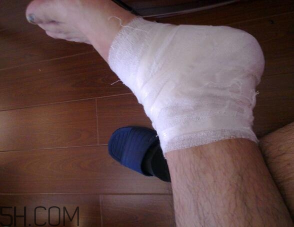 運(yùn)動損傷是怎么造成的？怎么預(yù)防出現(xiàn)運(yùn)動損傷？