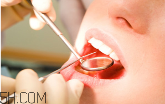 洗牙出血是正常嗎？洗牙后多久可以吃東西？