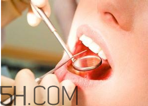 洗牙對牙齒好嗎？洗牙的6大誤區(qū)