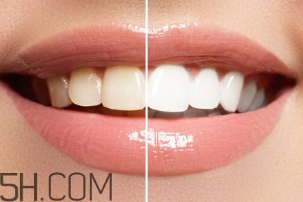 牙齒內(nèi)側(cè)的黃垢怎么去除？每天刷幾次牙齒最合適？