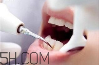 洗牙對牙齒好嗎？洗牙的6大誤區(qū)