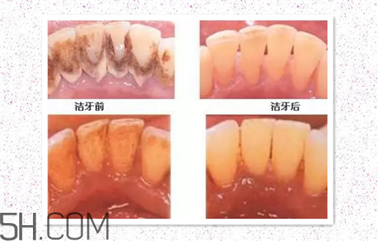 超聲波洗牙可以美白牙齒嗎？超聲波洗牙多少錢一次？
