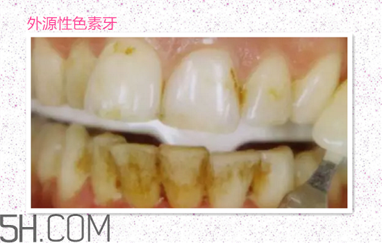 超聲波洗牙可以美白牙齒嗎？超聲波洗牙多少錢一次？