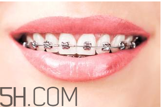 補牙需要帶牙套嗎？補牙后要裝牙套多少錢？