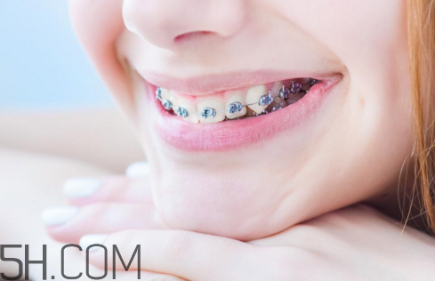 戴牙套怎么使用電動(dòng)牙刷？佩戴牙套的注意事項(xiàng)