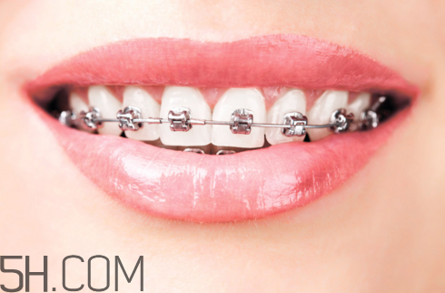 戴牙套可以懷孕嗎？牙齒矯正的后遺癥