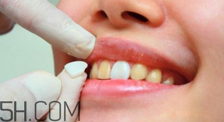 烤瓷牙取下來還能用嗎？瓷貼面美白對牙齒有損害嗎？