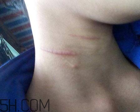 密麗除疤膏怎么用？密麗除疤膏什么時候用？