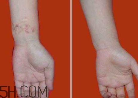 密麗除疤膏效果怎么樣？密麗除疤膏效果對比照