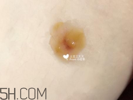 美寶濕潤(rùn)燒傷膏怎么樣？美寶濕潤(rùn)燒傷膏有用嗎？