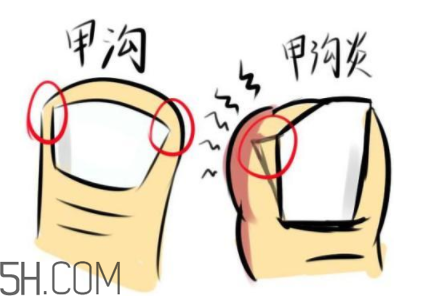 為什么容易得甲溝炎？怎么根治甲溝炎？