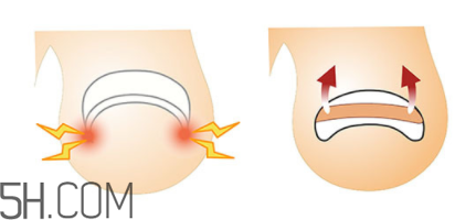 為什么容易得甲溝炎？怎么根治甲溝炎？