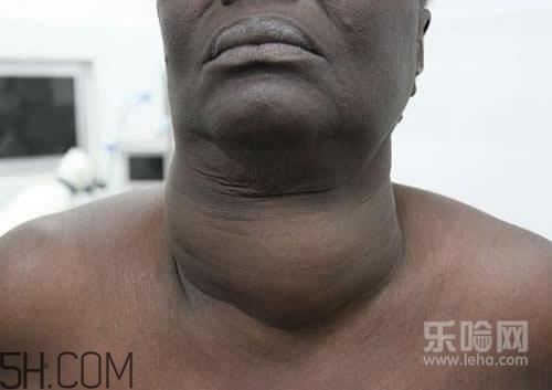 甲狀腺腫大和甲亢的區(qū)別有哪些？甲狀腺腫大適合吃什么食物？