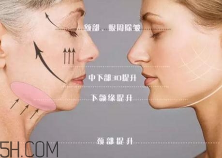 大v線提升有副作用嗎？大v線和小v線的區(qū)別