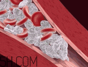 血栓究竟有多危險(xiǎn)？任何年齡都有可能得血栓