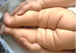 寶寶腿紋不對(duì)稱是怎么回事？嬰幼兒的生長(zhǎng)發(fā)育標(biāo)準(zhǔn)是怎樣的？