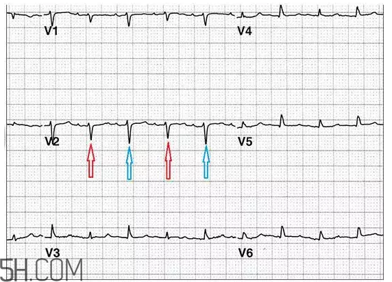 心電圖怎么看？6種常見心電圖異常情況