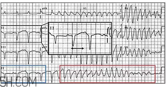 心電圖怎么看？6種常見心電圖異常情況