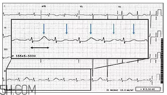 心電圖怎么看？6種常見心電圖異常情況