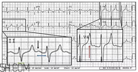 心電圖怎么看？6種常見心電圖異常情況