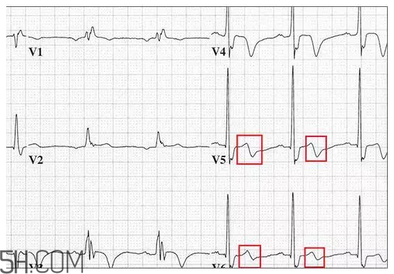 心電圖怎么看？6種常見心電圖異常情況