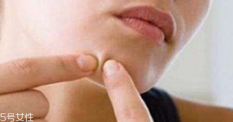 下巴起痘怎么辦？超好用祛痘辦法分享