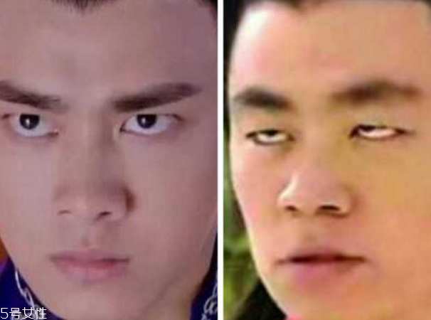 死魚眼怎么治？割雙眼皮可以治死魚眼