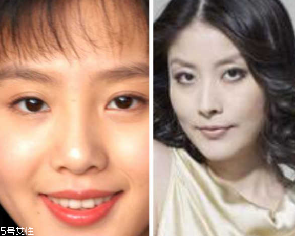 死魚眼怎么治？割雙眼皮可以治死魚眼