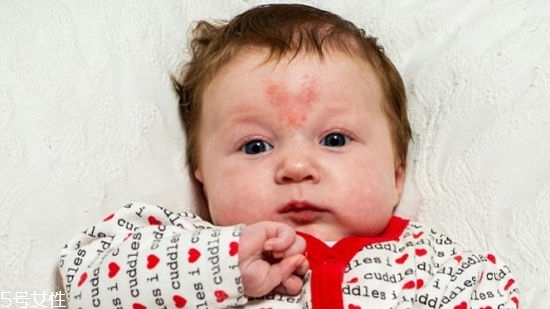 寶寶胎記會自動消失嗎？不同胎記消失情況不同