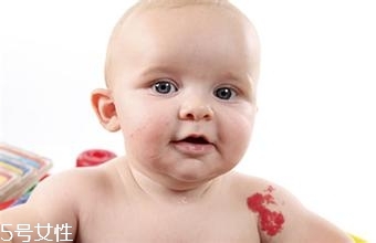 寶寶胎記會自動消失嗎？不同胎記消失情況不同