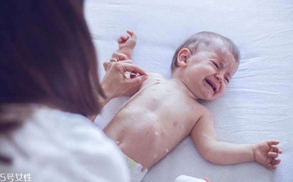 水痘有何傳播途徑？多發(fā)于春秋季