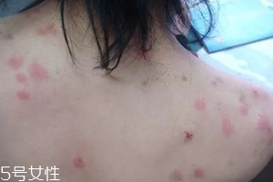 螨蟲有哪些危害？嚴(yán)重時(shí)肌膚糜爛