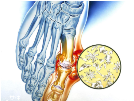 痛風(fēng)可以治愈嗎？無法治愈但能控制