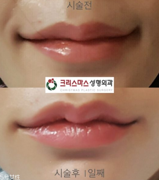 韓國人最愛整哪兒？韓國整形部位TOP4